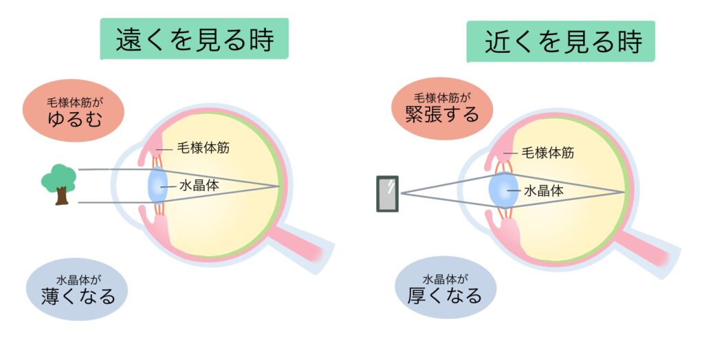 メガネ　過矯正