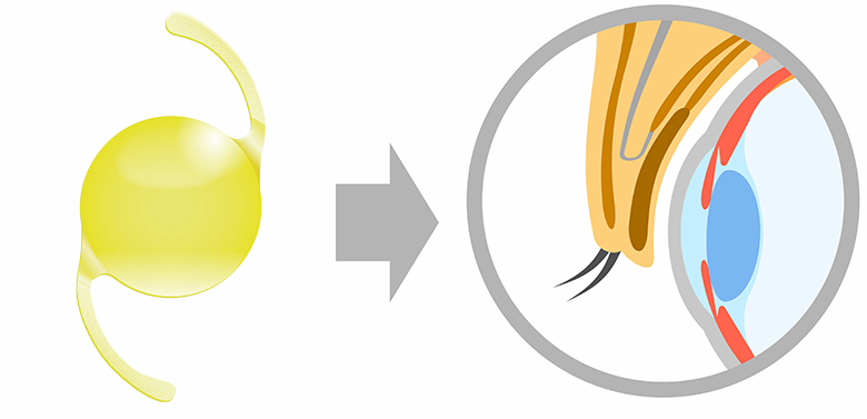 白内障　眼内レンズ