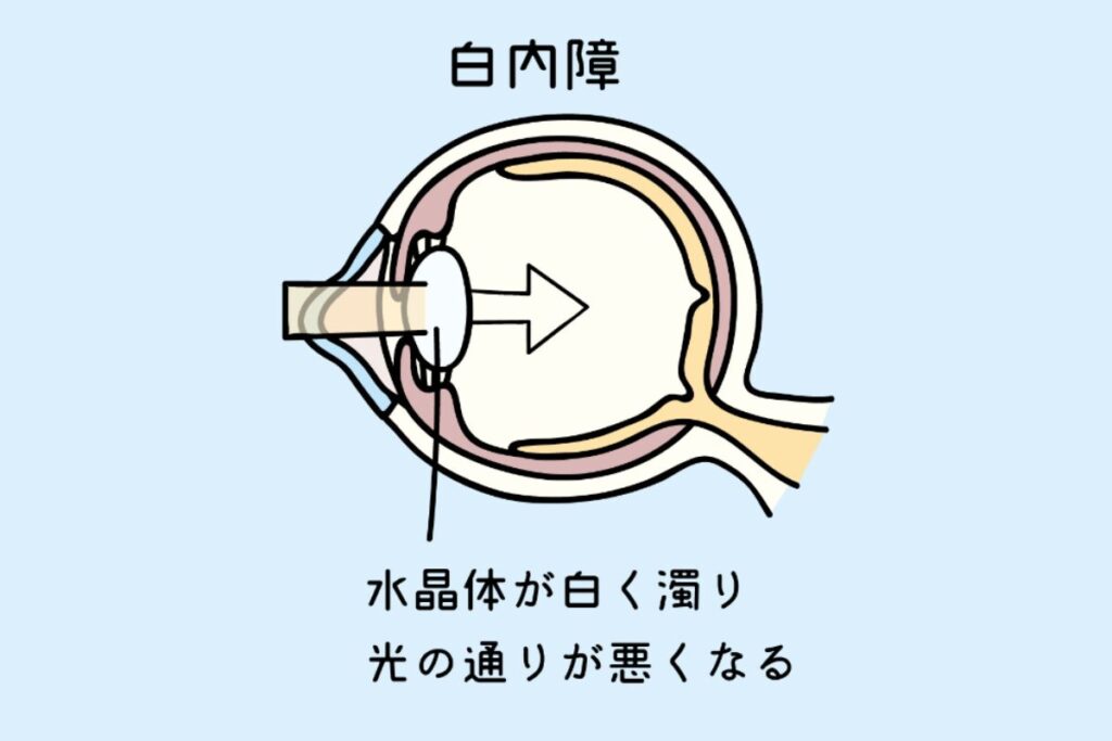 白内障
