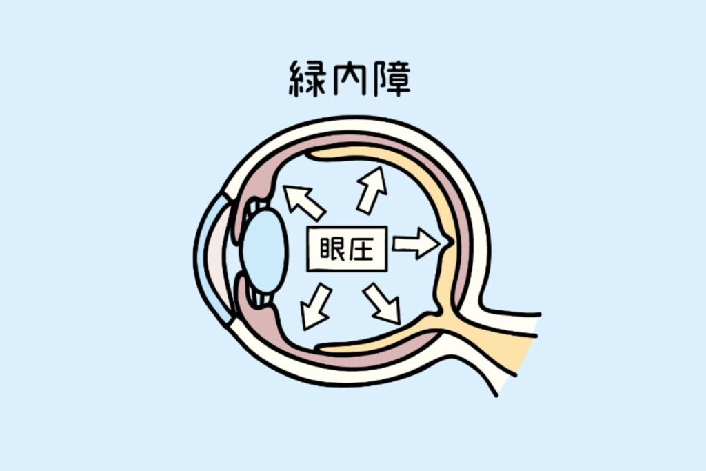 緑内障